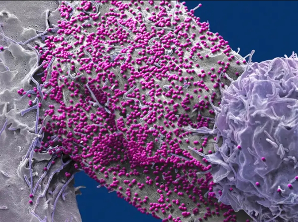 全球第七个治愈艾滋病的人出现了